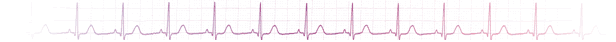 EKG Strip